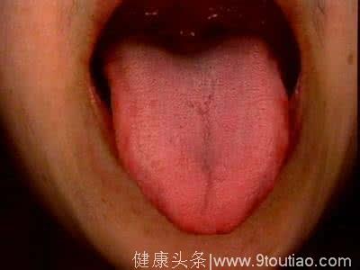 看一下舌头就知道你的湿气重不重，越早知道越好