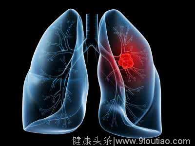 肺癌最实用的分型：小细胞肺癌和非小细胞肺癌
