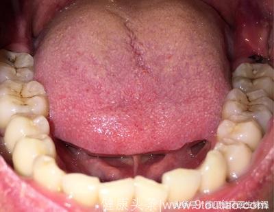 牙齿上的“黑点”能带来多大的危害，你知道吗？