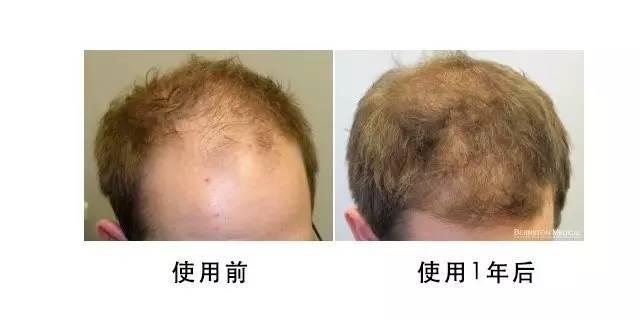 最新治疗脱发的有效药物已上市，秃顶人群有福了！