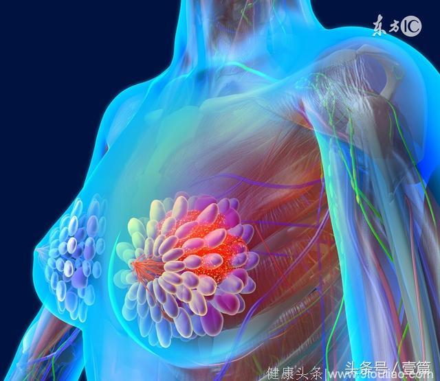 美国《临床肿瘤杂志》：罗氏新药T-DM1可替代乳腺癌新辅助化疗
