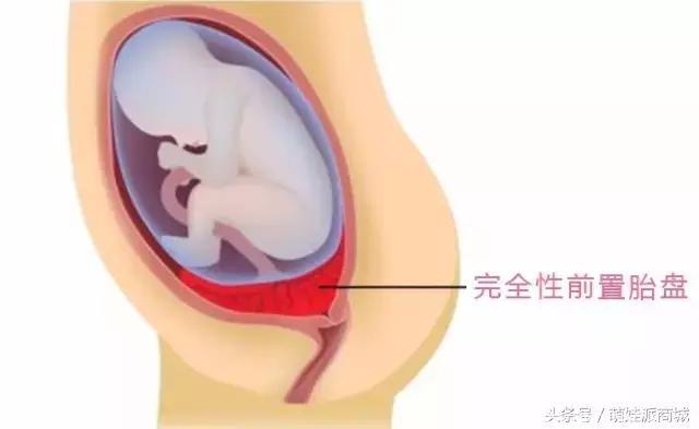 1/200的孕妇中招，胎盘低是怎么回事？