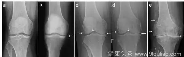 到底是“滑膜炎”，“骨质增生”，还是“关节炎”？