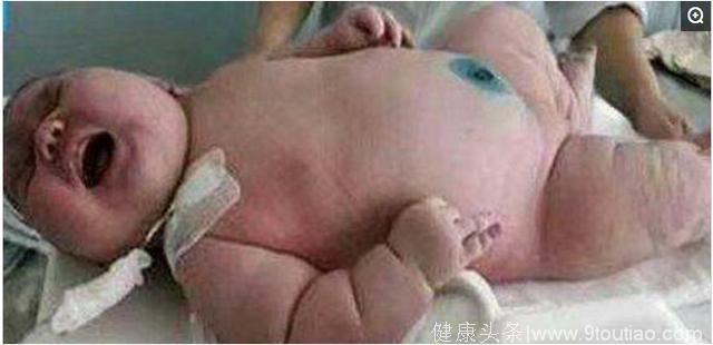 500斤女子舍命产子，生出的宝宝后医生累垮！