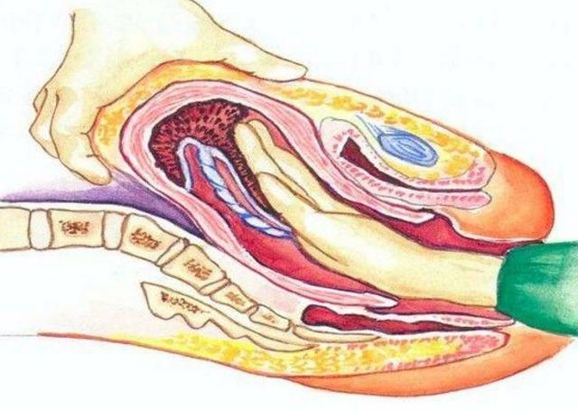 生完孩子胎盘出不来，医生将胳膊伸进“下面”往外掏！