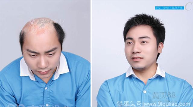 导致脱发原因究竟是什么？你造吗，生发液脂溢性防脱发秃顶头发增长液增发密发育发男女快速防掉发