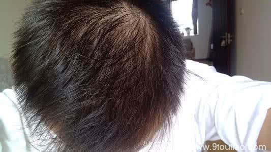 导致脱发原因究竟是什么？你造吗，生发液脂溢性防脱发秃顶头发增长液增发密发育发男女快速防掉发