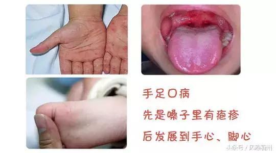 义乌的孩子们受苦了！最近流行的这个病，家长们要小心！