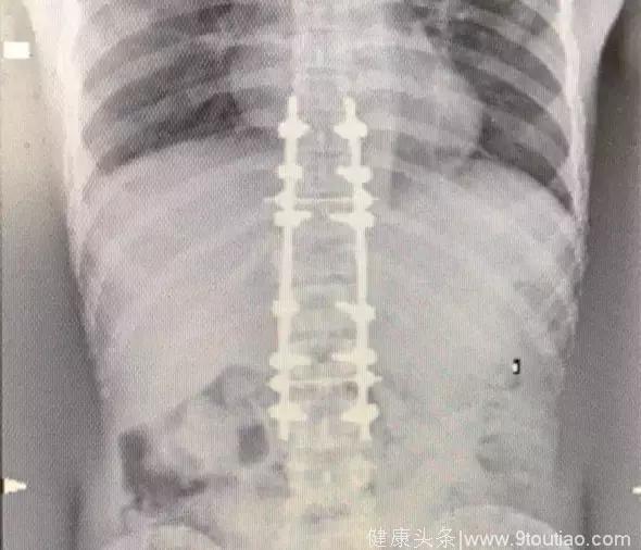 28岁修车工被高处跌落砸断脊柱，送到医院医生说没得治了！