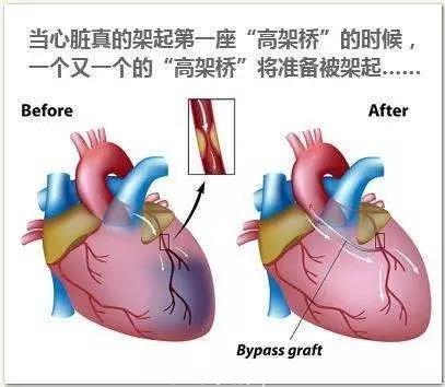 治疗冠心病的支架搭桥，背后原来还隐瞒了这么多的事