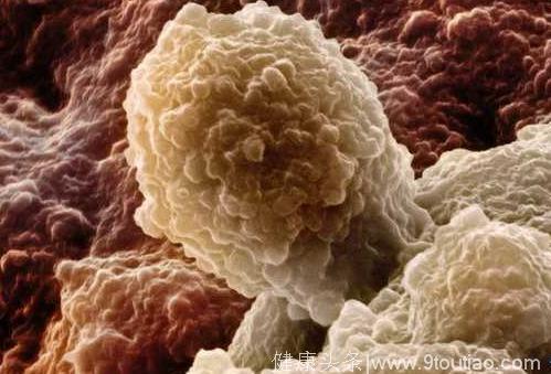“癌中之王”胰腺癌有3大特点、5大病症！