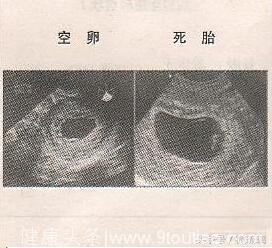 孕妈怀胎9月，去医院检查却是死胎，原因指向高血糖