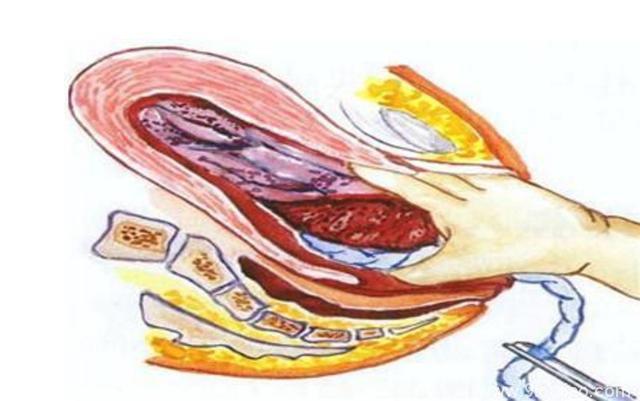生完孩子胎盘却出不来，医生将胳膊伸进“下面”往外掏