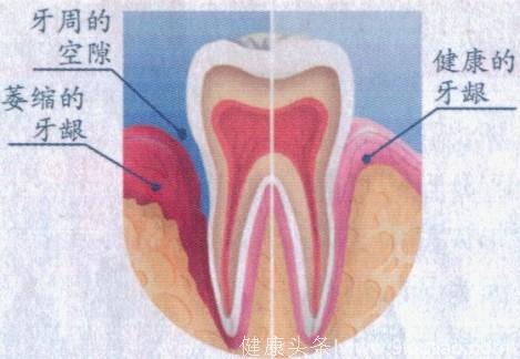 有些人牙齿会变长，咬硬的东西就酸软酸痛，怎么回事？