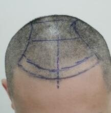 北京无痕植发价格23800元不怕秃顶，植发过程多图对比分享