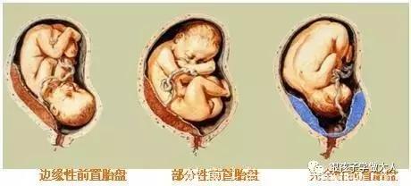 孕期最可怕的9种身体信号！发现晚了胎儿救不回来了！