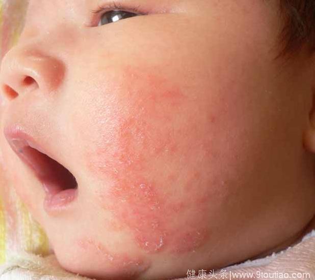 对于宝宝湿疹的认识，你在误区吗？