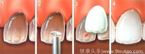 深圳麦芽口腔知识分享：牙齿贴面适合牙釉质发育不全的牙齿吗？