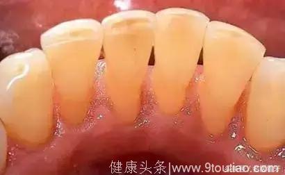 北大口腔博士王玉玮解惑：牙医，为什么总让你洗牙？