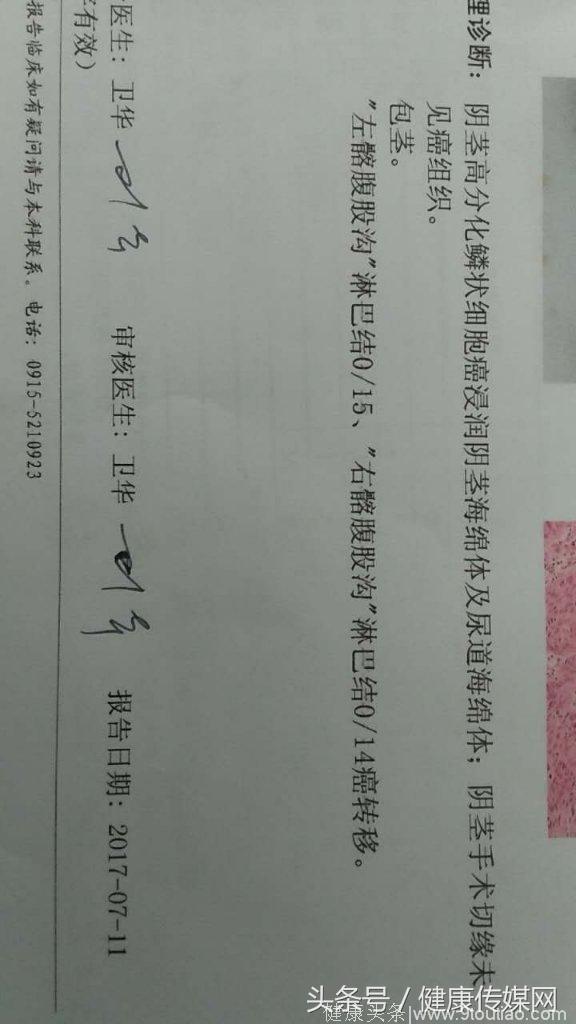 汉阴县人民医院普外二科为一阴茎癌患者精准诊治