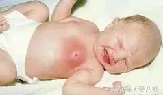 刚出生几天的宝宝乳房肿大，婆媳自作聪明帮消肿，被医生痛训：无知