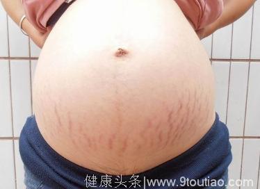 在整个孕期肚子都没有长妊娠纹，在临产时却全都出来了