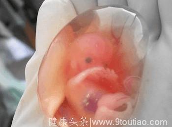 女子多次备孕无果，医生检查竟从子宫内取出5块胎儿尸骨，实在太惊悚