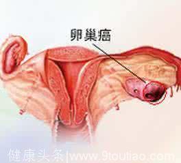 卵巢癌的临床表现