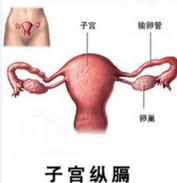 孕妇屡次遭“胚停”原是子宫纵隔惹的祸