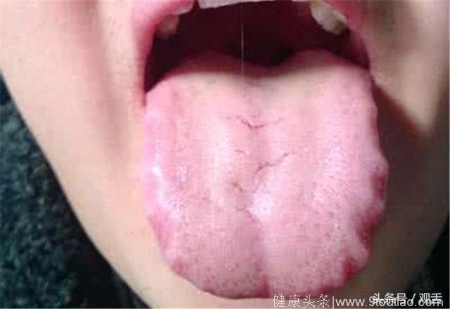 舌诊科普篇：湿气重舌头像锯子，花三分钟看一下，对你绝对有帮助！