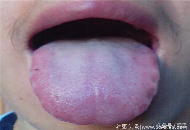 舌诊科普篇：湿气重舌头像锯子，花三分钟看一下，对你绝对有帮助！
