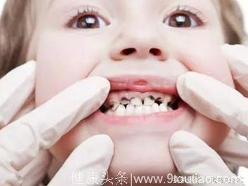 “孩子蛀牙不要紧，换了牙就会好”的育儿误区要不得！儿童口腔问题要这样处理
