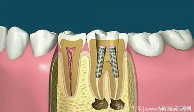 北大口腔博士王玉玮细述：根管治疗术治疗龋齿的全过程