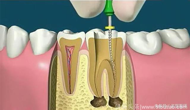 北大口腔博士王玉玮细述：根管治疗术治疗龋齿的全过程