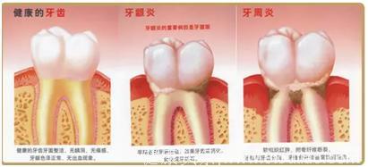 牙龈出血、牙缝大竟然与牙周炎有关？