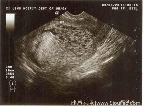 怀孕后到医院检查，肚子里确是成串的水泡，确诊为葡萄胎，那么什么是葡萄胎？