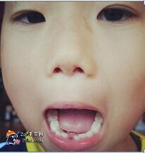 日本牙医没有经过本人或监护人同意，直接拔掉30名儿童的牙齿