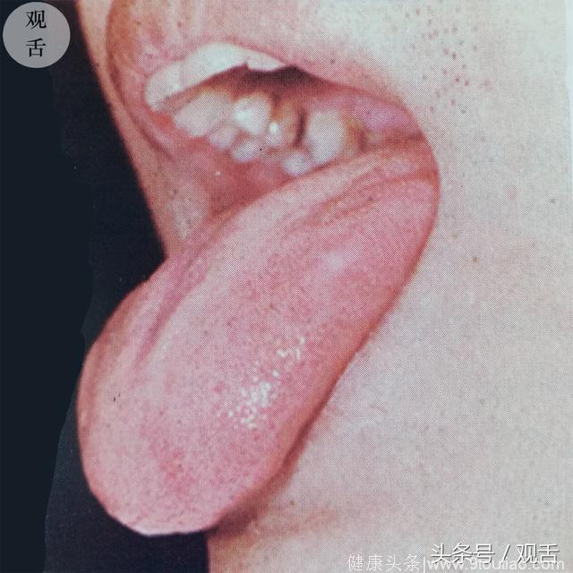 观舌识病：老中医教你识舌苔，典型舌像介绍——正常舌像