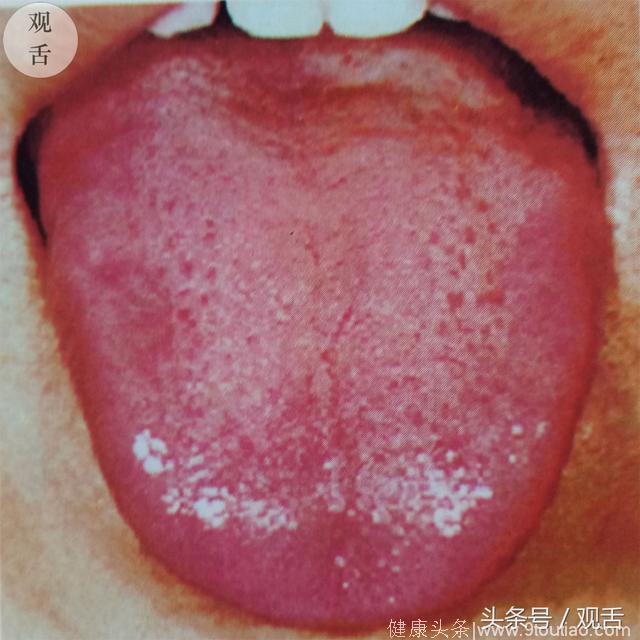 观舌识病：老中医教你识舌苔，典型舌像介绍——正常舌像