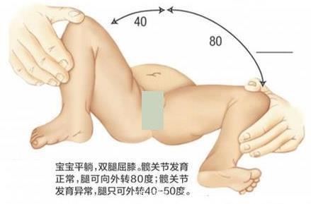 孩子腿纹不对称，家长千万别忽视！——一个先天性髋关节发育不良的宝宝的治愈之路