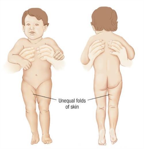 孩子腿纹不对称，家长千万别忽视！——一个先天性髋关节发育不良的宝宝的治愈之路