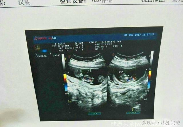 真实案例！B超单带你见证单胎变双胎的奇迹！