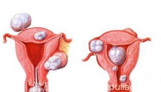 哪些症状的出现是“子宫肌瘤”的前奏