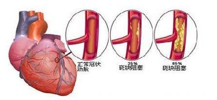 突发冠心病、心梗、猝死？不存在的！动脉硬化是个“顺其自然”的病