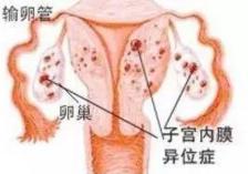 子宫内膜异位症确诊需做哪四种检查