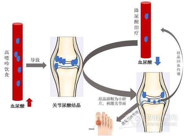 痛风发作，止痛就行了吗？降尿酸才是根本！