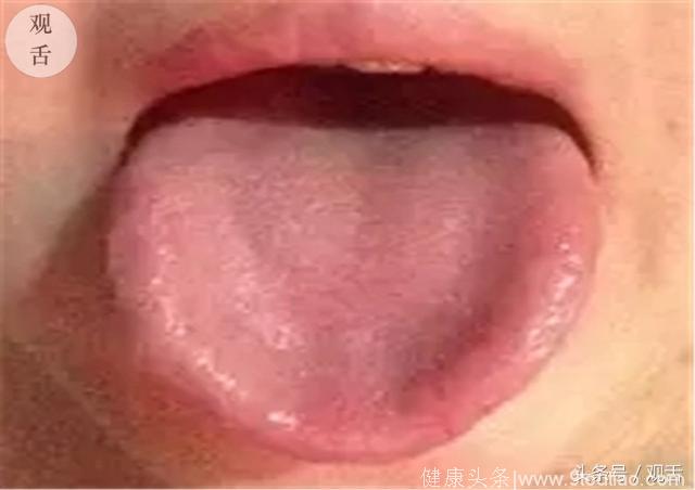 舌诊珍藏篇：看舌苔辨体质知健康，你也可以学会！建议收藏