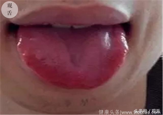 舌诊珍藏篇：看舌苔辨体质知健康，你也可以学会！建议收藏