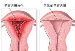有效预防子宫内膜增生的几个小妙招
