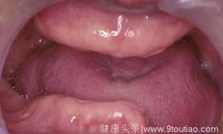 警惕！长期口腔溃疡可能导致口腔癌！